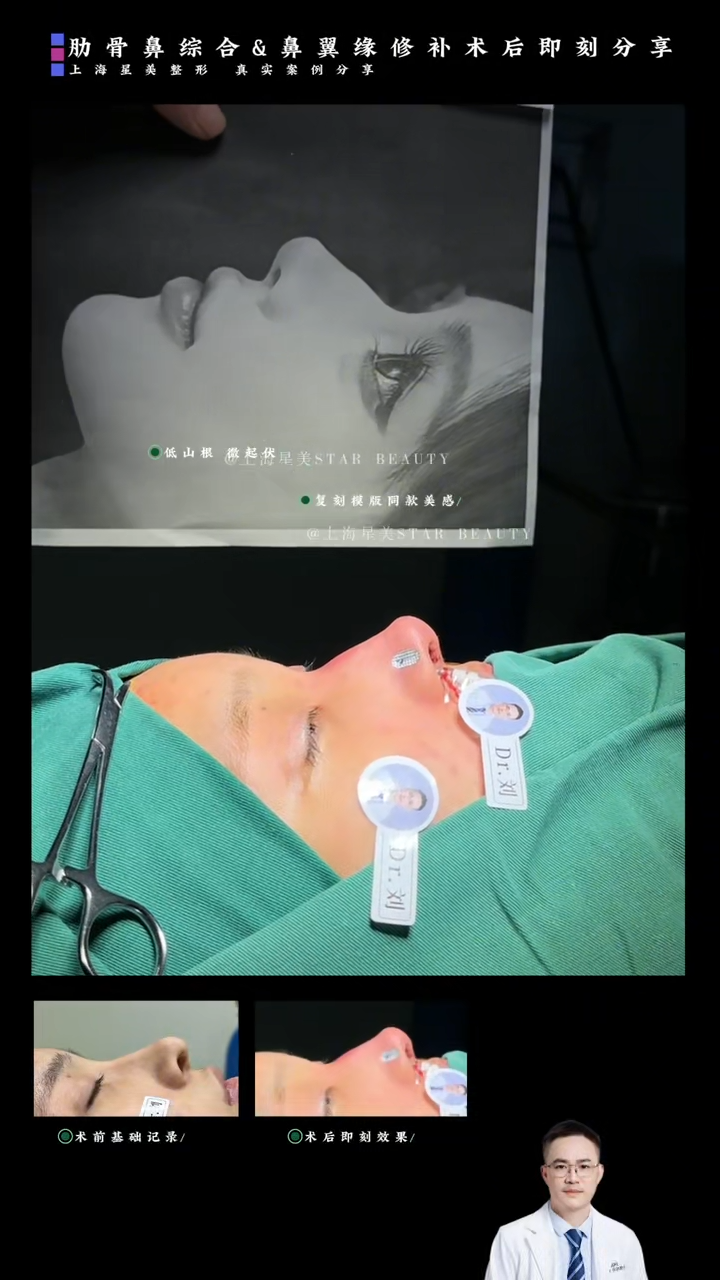 肋骨鼻綜合 + 鼻翼緣修補 術後即刻案例：一台"鼻尖支撐 + 鼻翼緣復位"的聯合方案