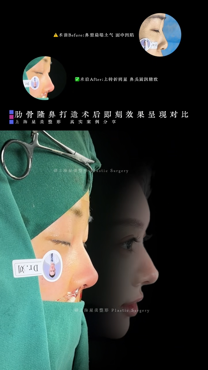 肋骨隆鼻打造術後即刻效果呈現對比
