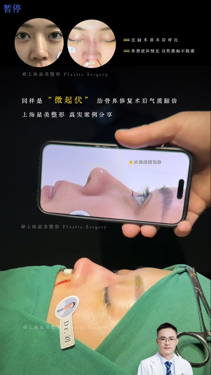 微起伏肋骨鼻修復