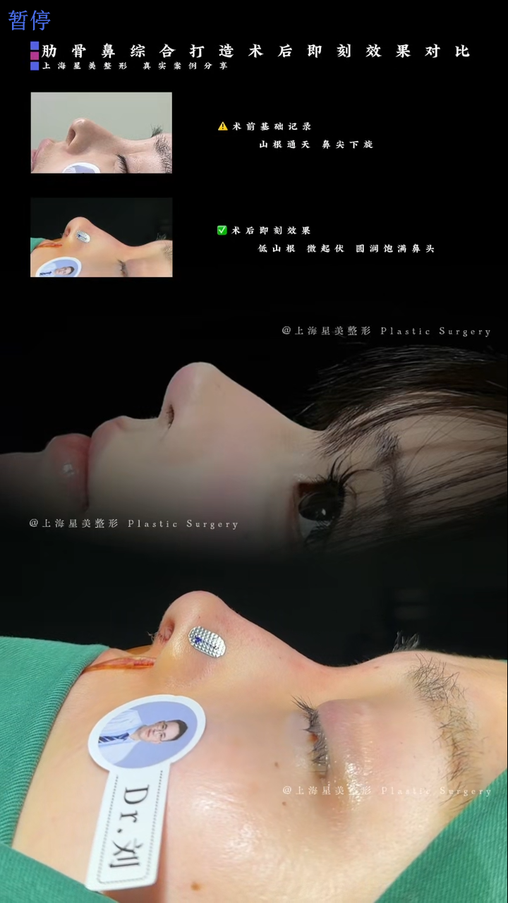 肋骨鼻綜合術後即刻對比